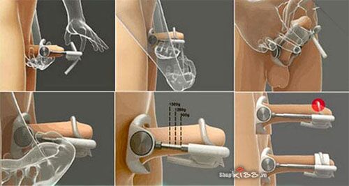 Dụng cụ kéo dài dương vật Pro Extender ABS kim loại nhập Mỹ chất lượng Dụng cụ kéo dài dương vật Pro Extender ABS kim loại nhập Mỹ chất lượng