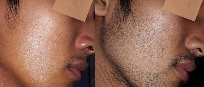 Minoxidil 5% Bọt Tăng Mọc Râu Nhanh, Hiệu Quả, An Toàn SHP972 Minoxidil 5% Bọt Tăng Mọc Râu Nhanh, Hiệu Quả, An Toàn SHP972