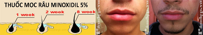 Minoxidil 5% Bọt Tăng Mọc Râu Nhanh, Hiệu Quả, An Toàn SHP972 Minoxidil 5% Bọt Tăng Mọc Râu Nhanh, Hiệu Quả, An Toàn SHP972